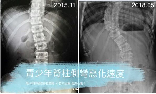 我有脊柱側彎，若不治療，會惡化嗎？系統性整理