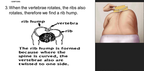 原來脊柱側彎也有假的? 教你辨別''真''假''脊柱側彎!!