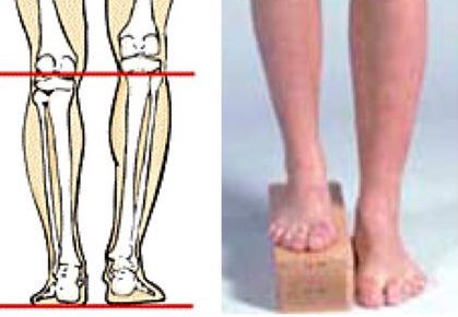 Myth of foot orthosis and wedge insoles toward scoliosis