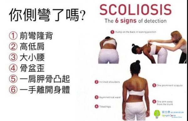 你側彎了嗎? 自我檢查法