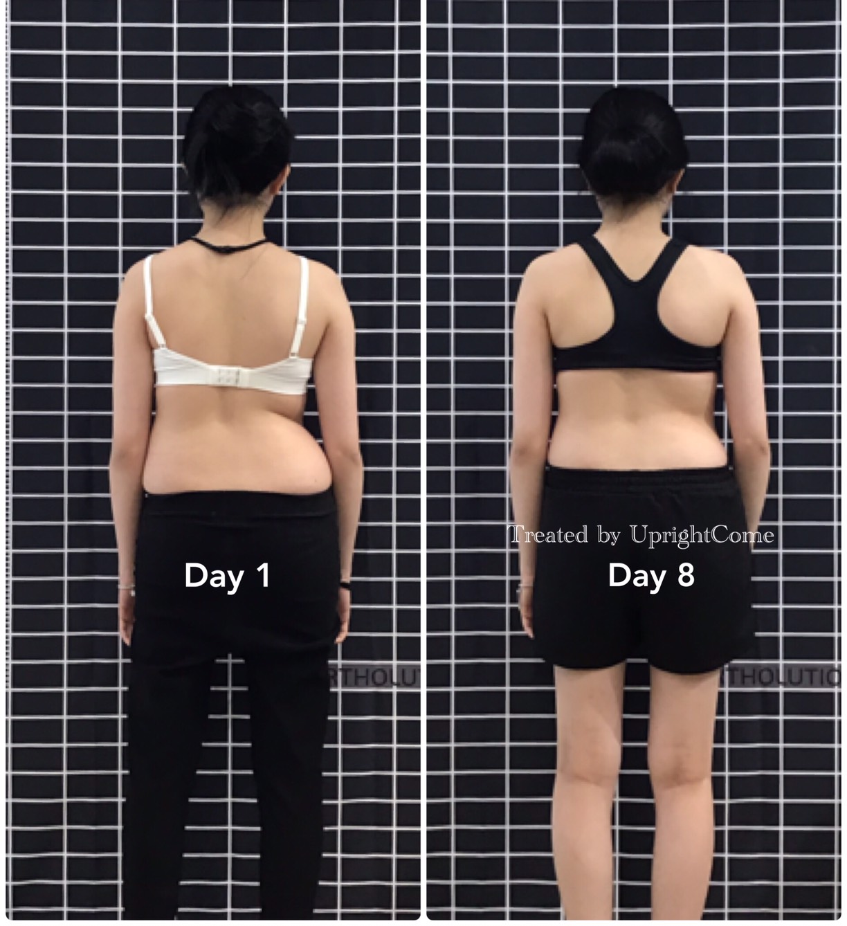 Come to Taiwan for Scoliosis Treatment ?