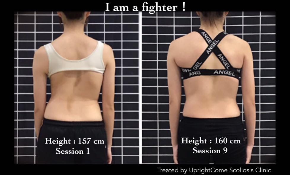 A 15-year-old girl with scoliosis in 69 degrees