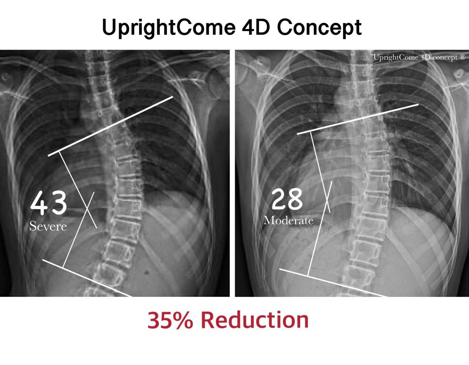 脊椎側彎，真的不想開刀！
