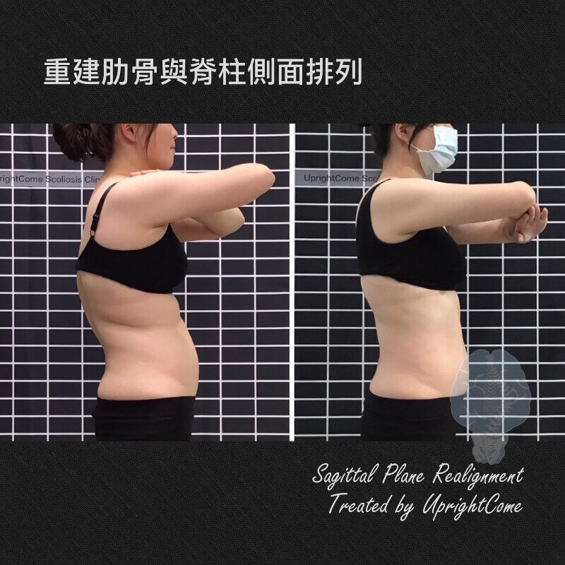 脊椎側彎容易忽視的側面曲線