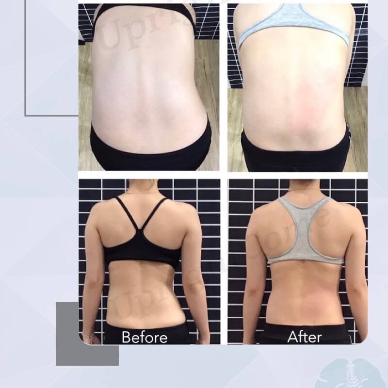 脊椎側彎矯正，久違了！美形腰線