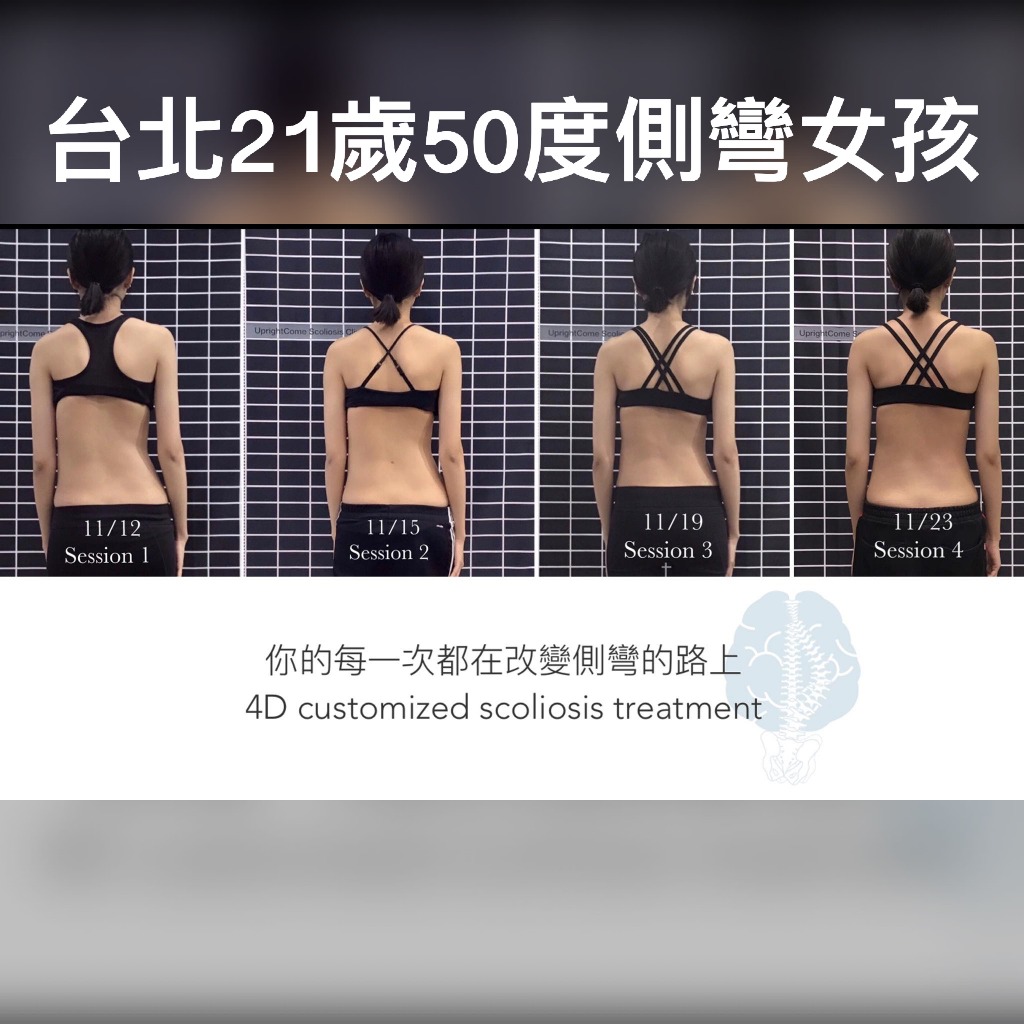 台北21歲50度側彎女孩，4次治療後，越來越正了！