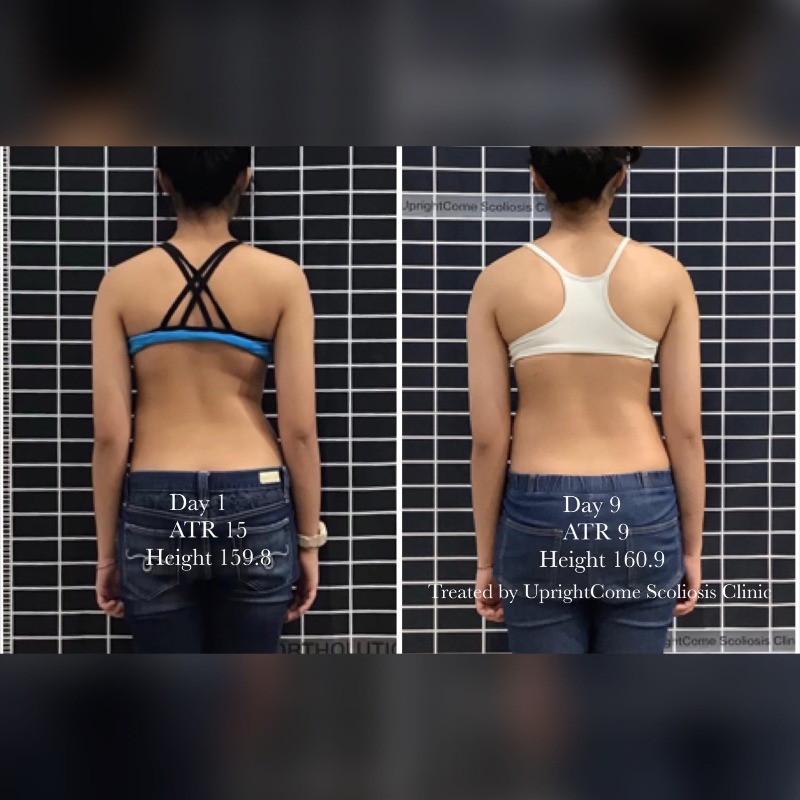 脊椎側彎國際患者九天密集治療