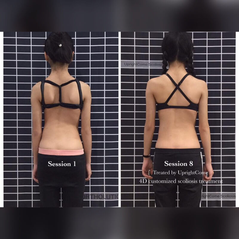 脊椎側彎的胸椎前凹 Loss of thoracic kyphosis