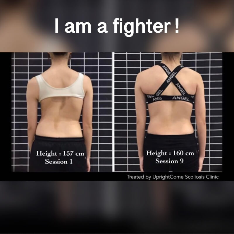 來自苗栗 15 歲 69 度脊椎側彎女孩的故事