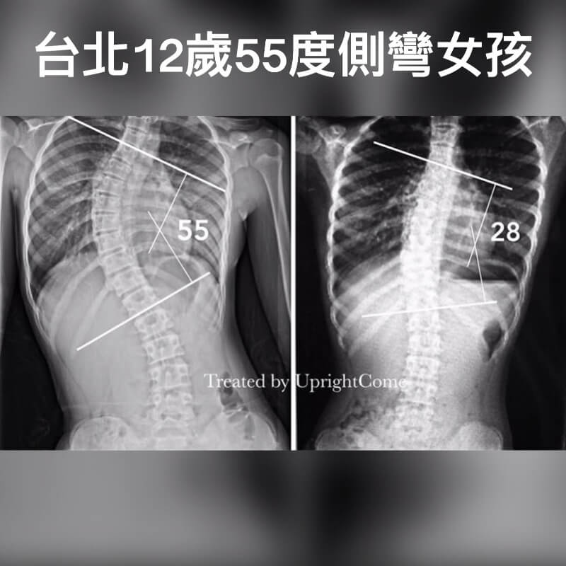 台北 12 歲 55 度重度脊椎側彎女孩