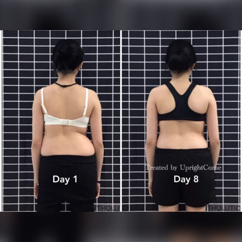 專程跨海來台治療脊椎側彎