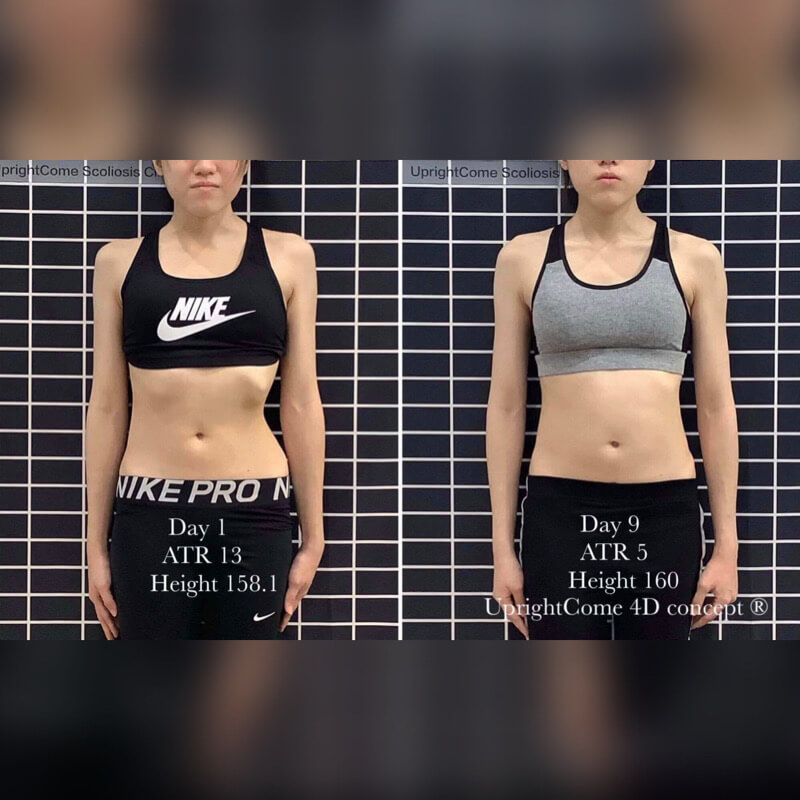 脊椎側彎國際治療