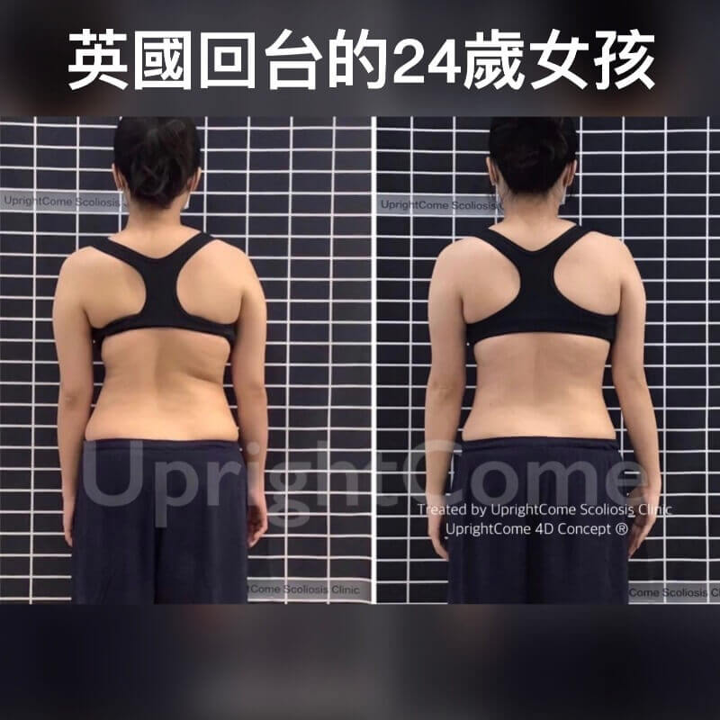 讓不願平凡的脊椎側彎患者，全力以赴到感動自己