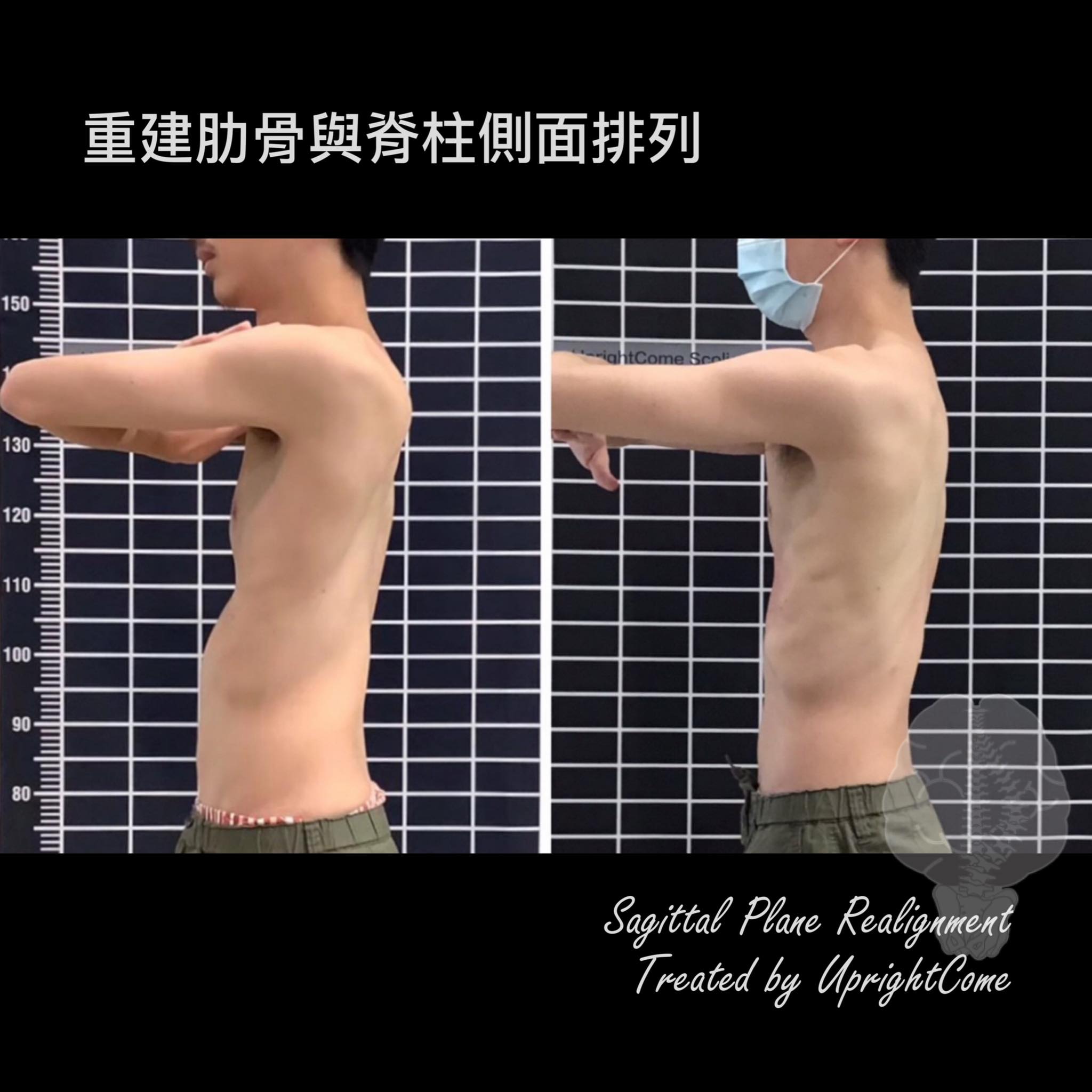A boy from Taichung with 47 degree thoracic scoliosis