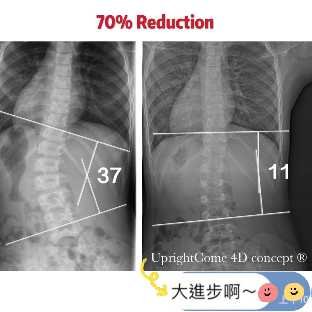 It's lucky to find a scoliosis specialist
