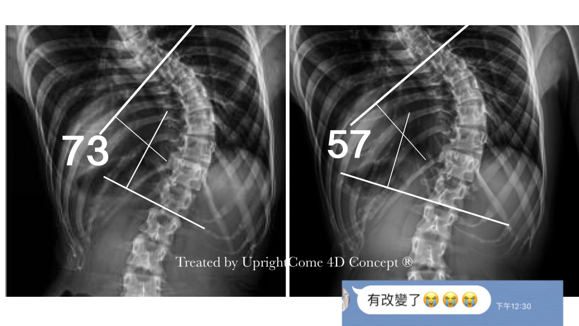 My scoliosis has changed !