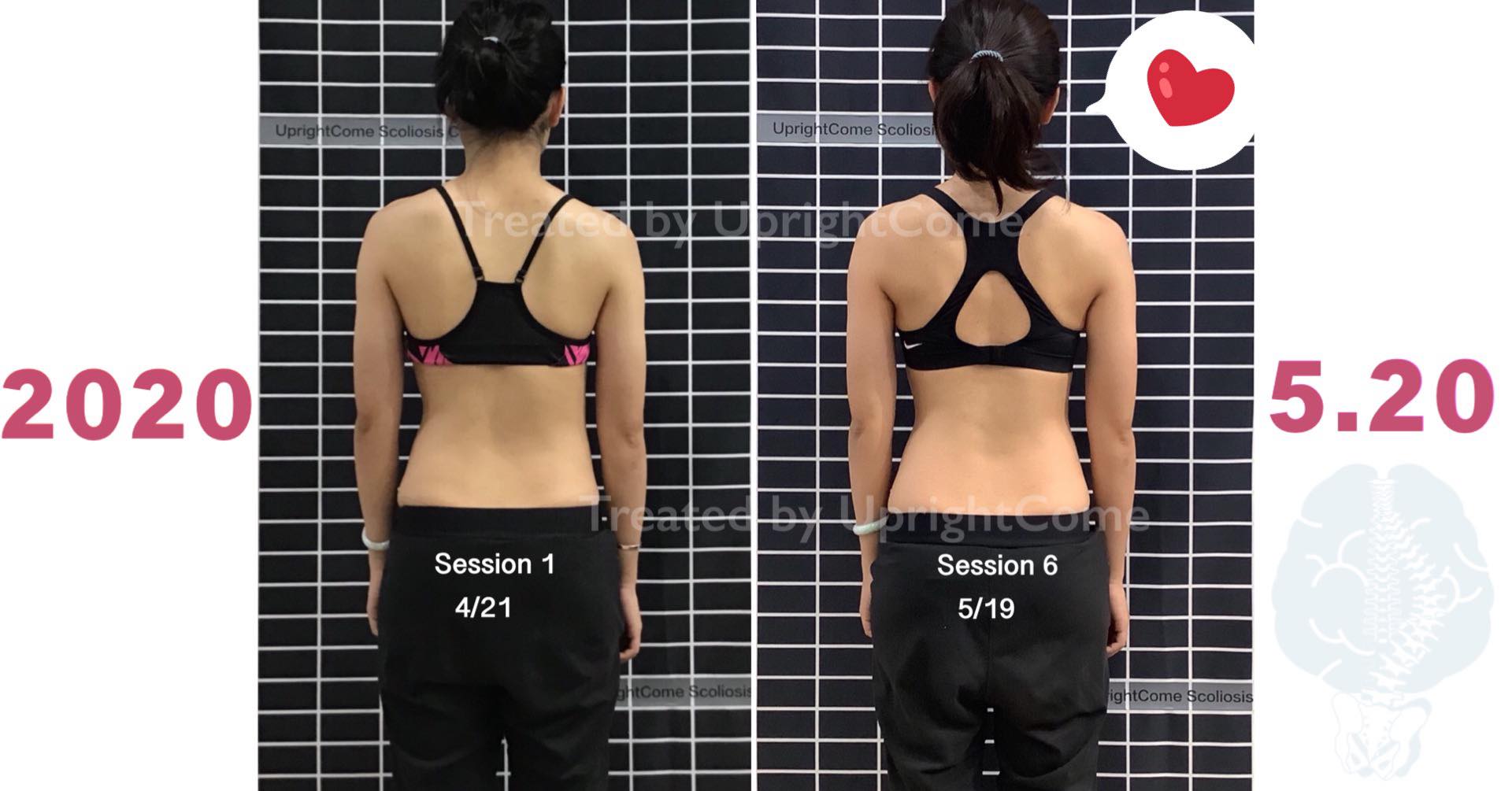 Why did you choose to come to UprightCome for scoliosis treatment?