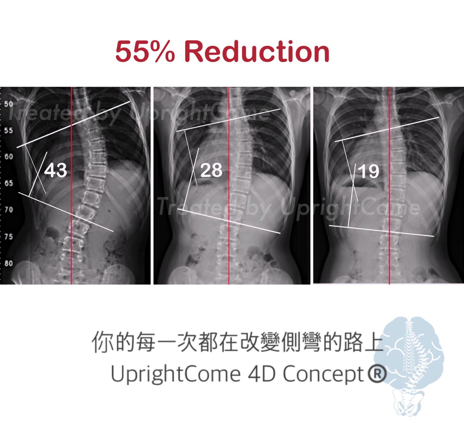 Is surgery necessary for severe scoliosis?