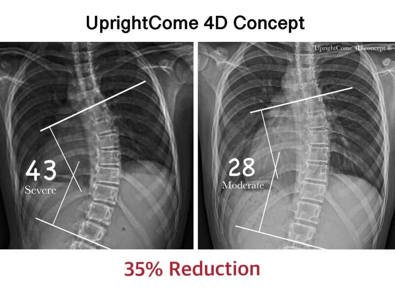 I really don't want to have an operation for scoliosis!