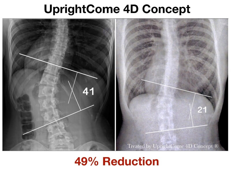 Good news in Christmas : The Cobb angle show 49% reduction