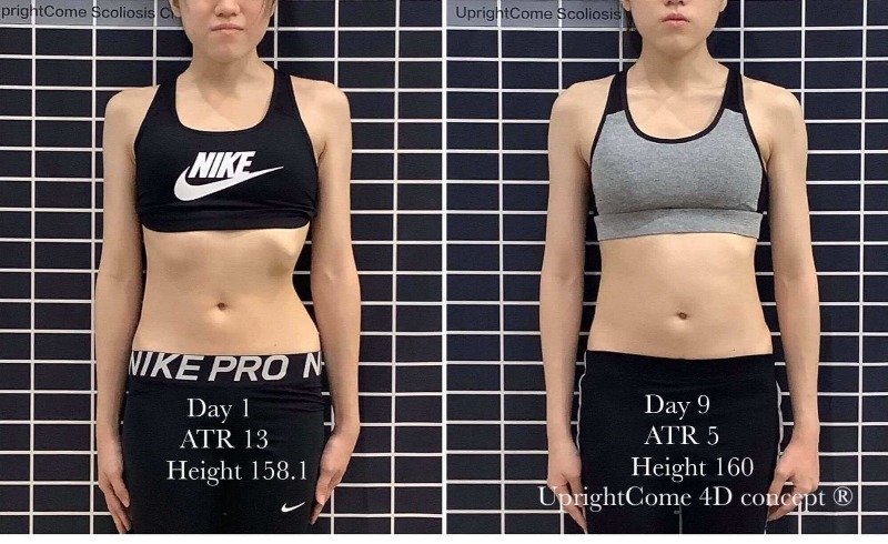 Scoliosis treatment for International patients