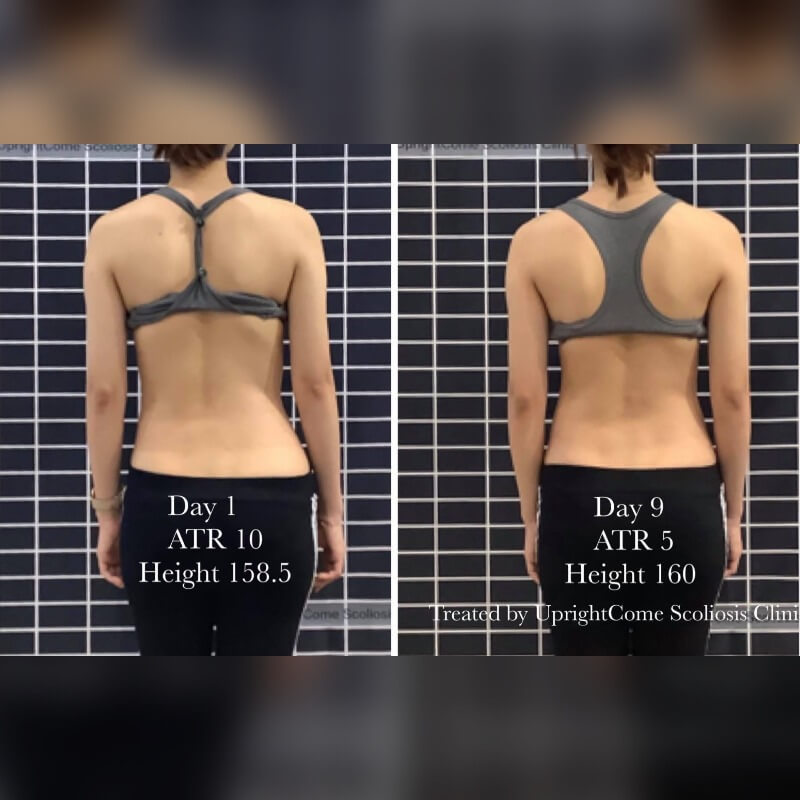 Intensive nine-day scoliosis treatment for overseas patients