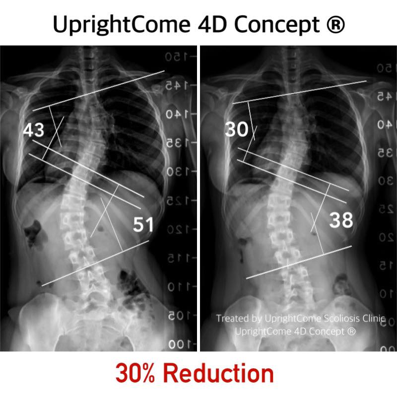 解開脊椎側彎旋轉密碼