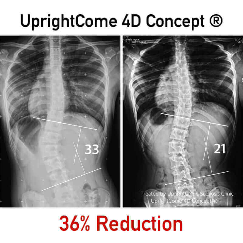 跟脊椎側彎惡化 say goodbye！