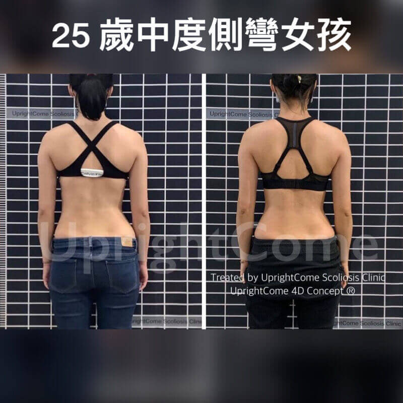 我只想脊椎側彎好起來