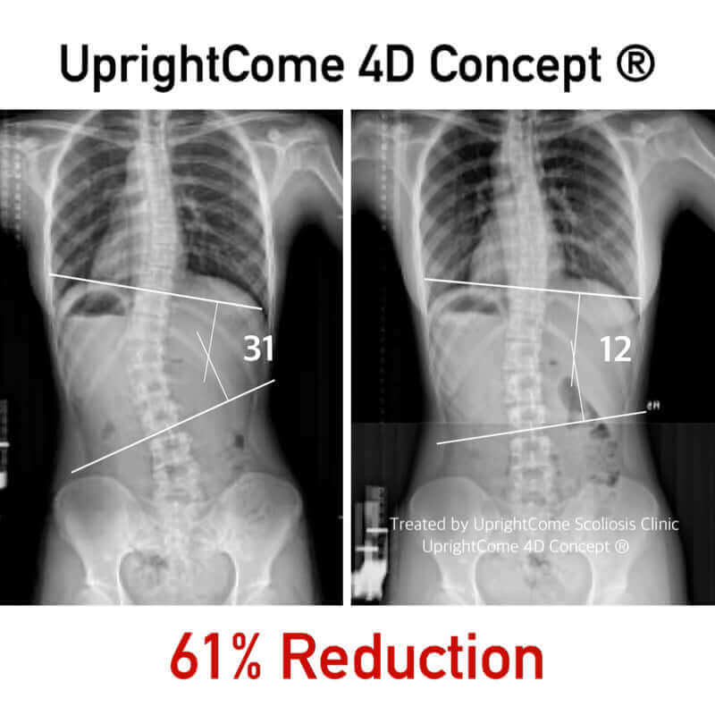 側彎數字會說話！