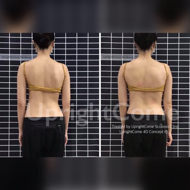 為了脊椎側彎的你，一直走在最前面