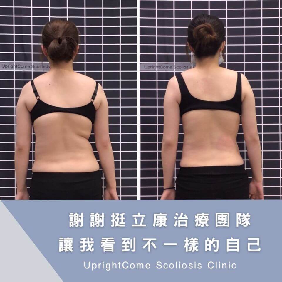 側彎造成的凹陷不再這麼明顯，讓我覺得很不可思議！
