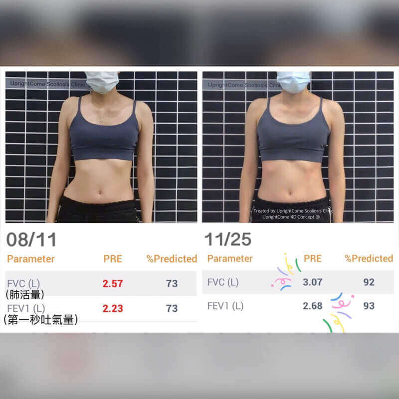 你知道脊椎側彎會影響呼吸嗎？