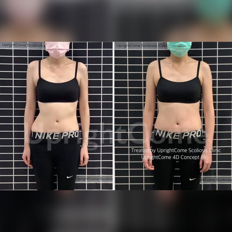 給脊椎側彎的自己變正的機會！