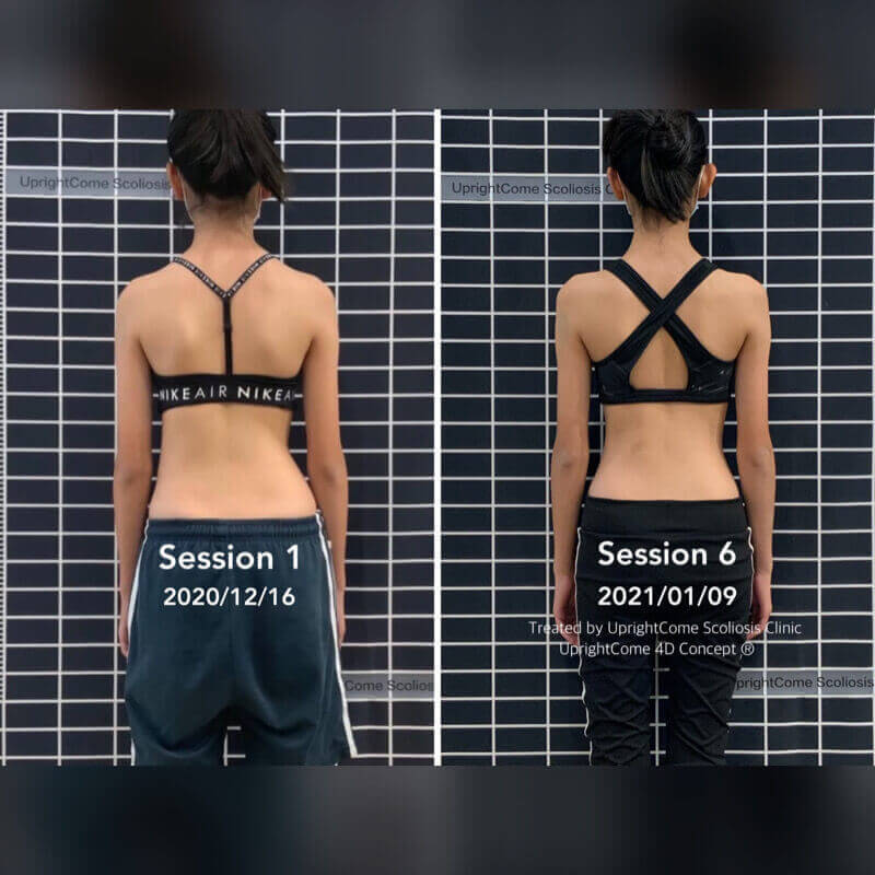 Scoliosis case sharing - The angle of trunk rotation is reduced from 8 degrees to 3 degrees
