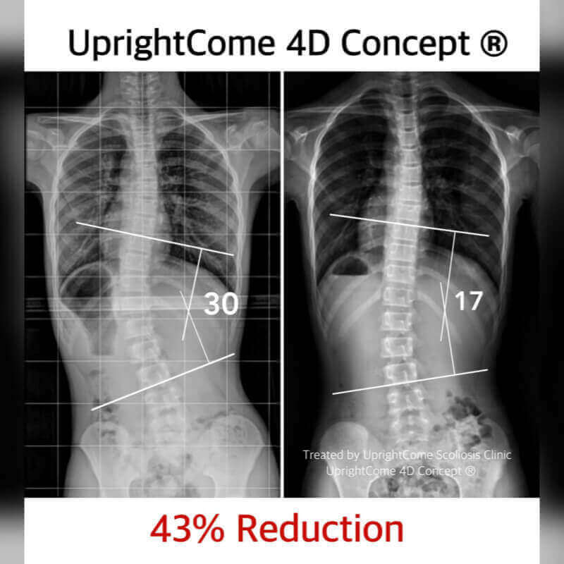A scoliosis success story - A journey from 30 degrees to 17 degrees