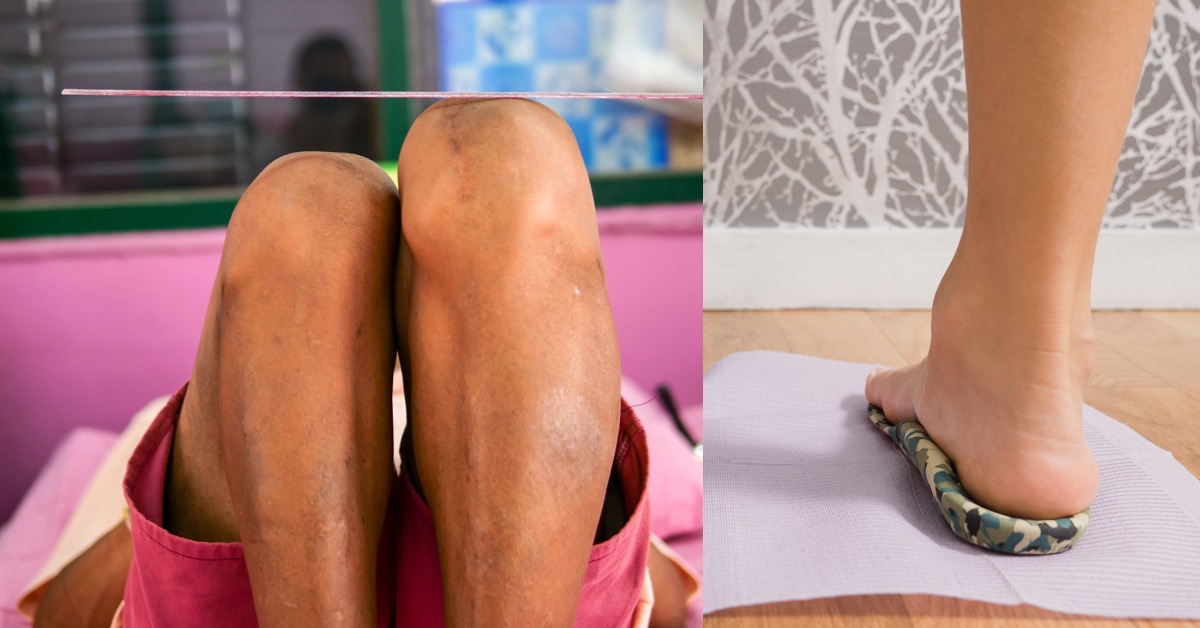 淺談脊椎側彎矯正鞋墊的迷思？