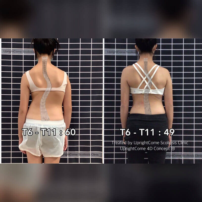 Scoliosis success story - The cobb angle was improved from 60 degrees to 49 degrees
