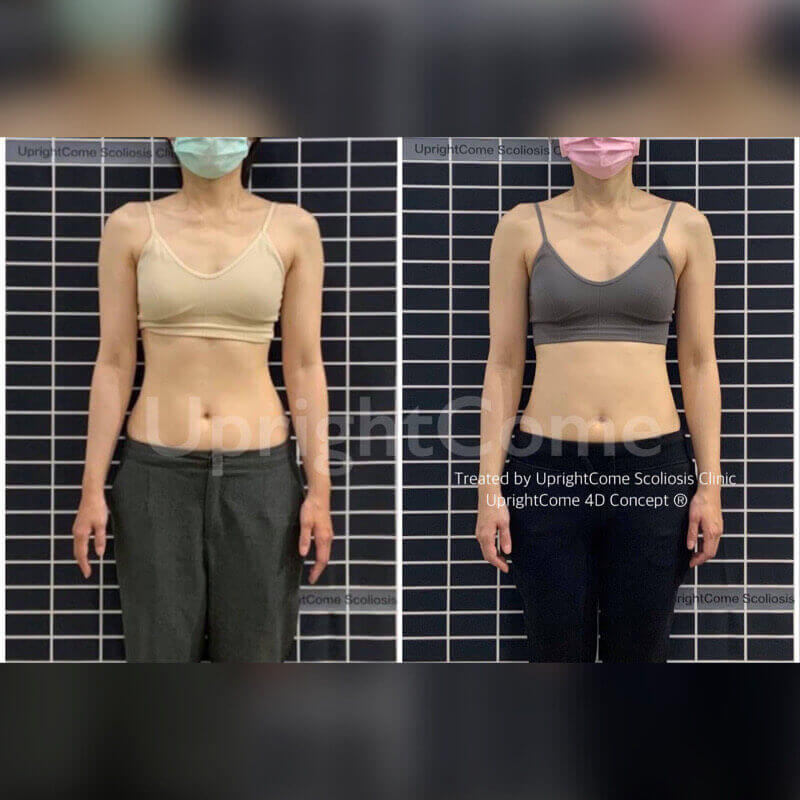 脊椎側彎矯正，你找對方法了嗎？
