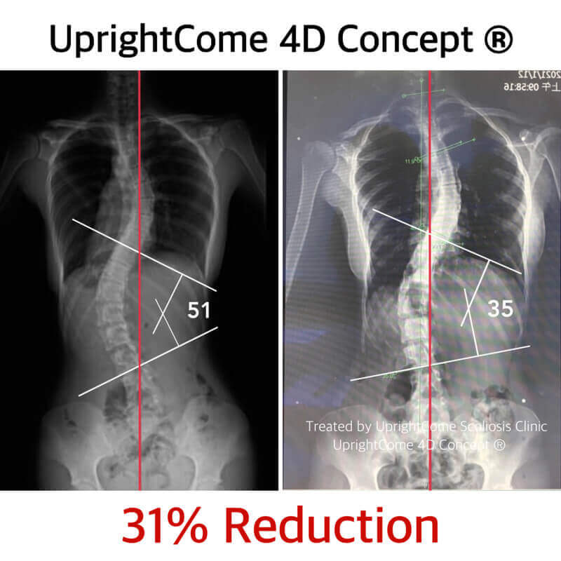 Scoliosis Curve Reduction – Cobb Angle from 51 degrees to 35 degrees