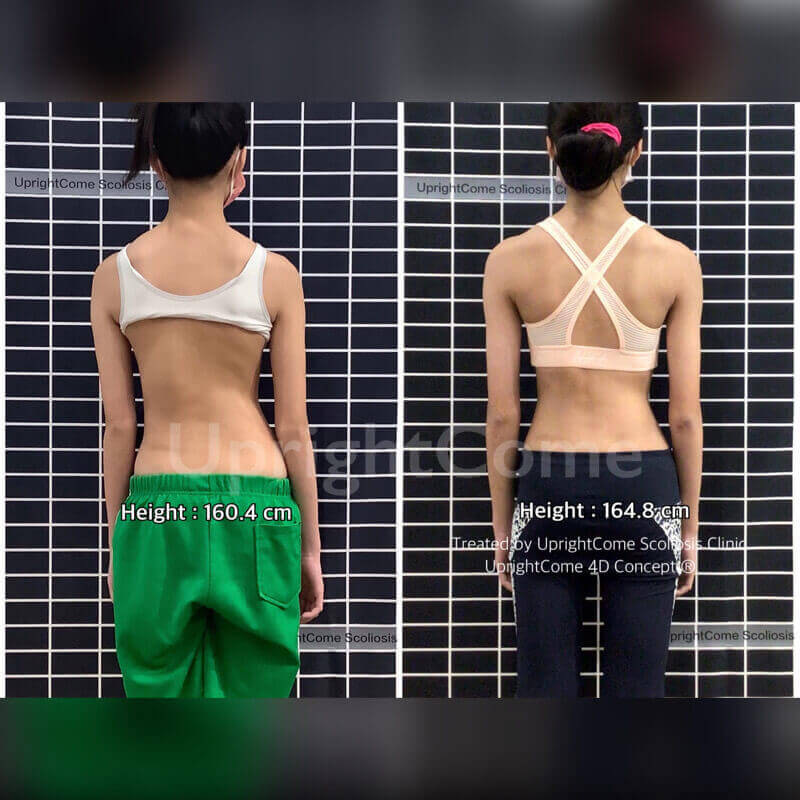 你的側彎，一點一滴在改變！