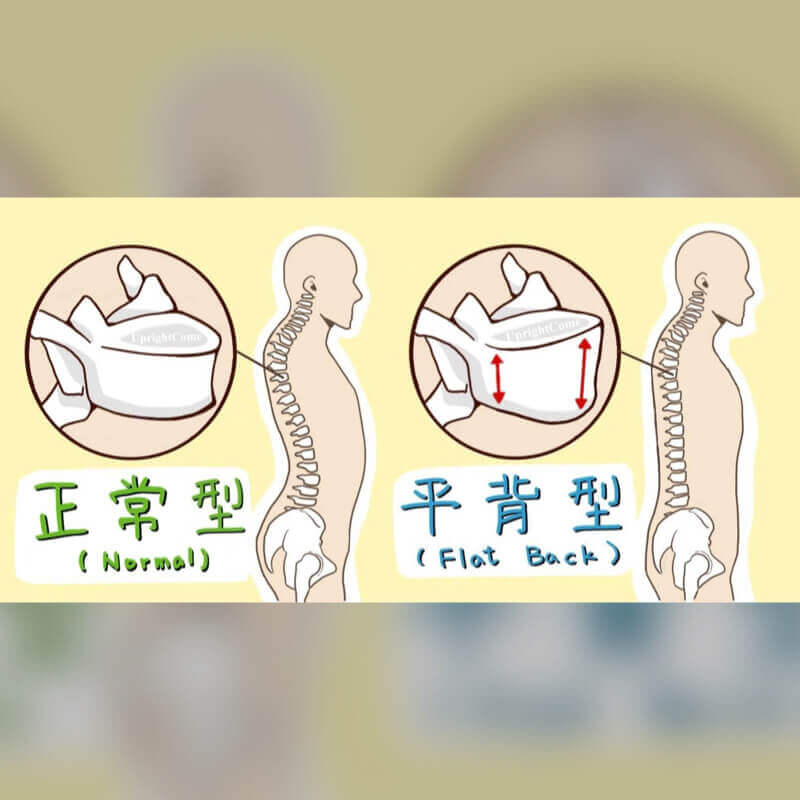 原發型脊椎側彎椎體結構改變可能產生的問題 - 平背