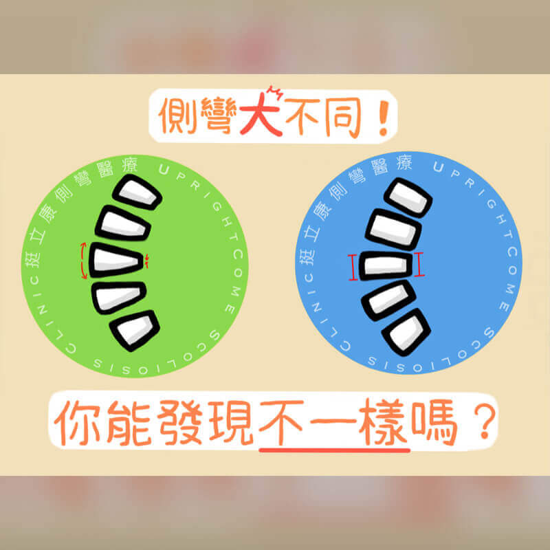 脊椎側彎大不同