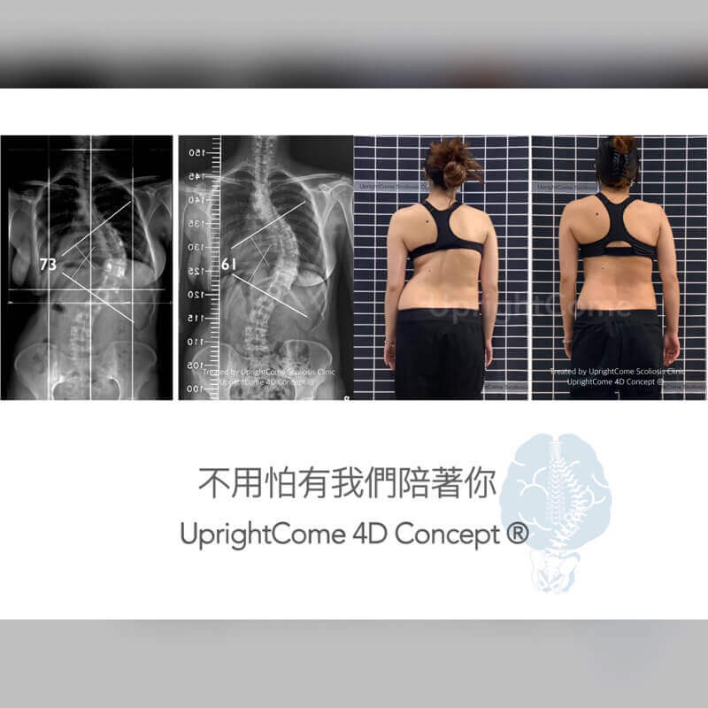 面對脊椎側彎，你也能掌握自己的命運！