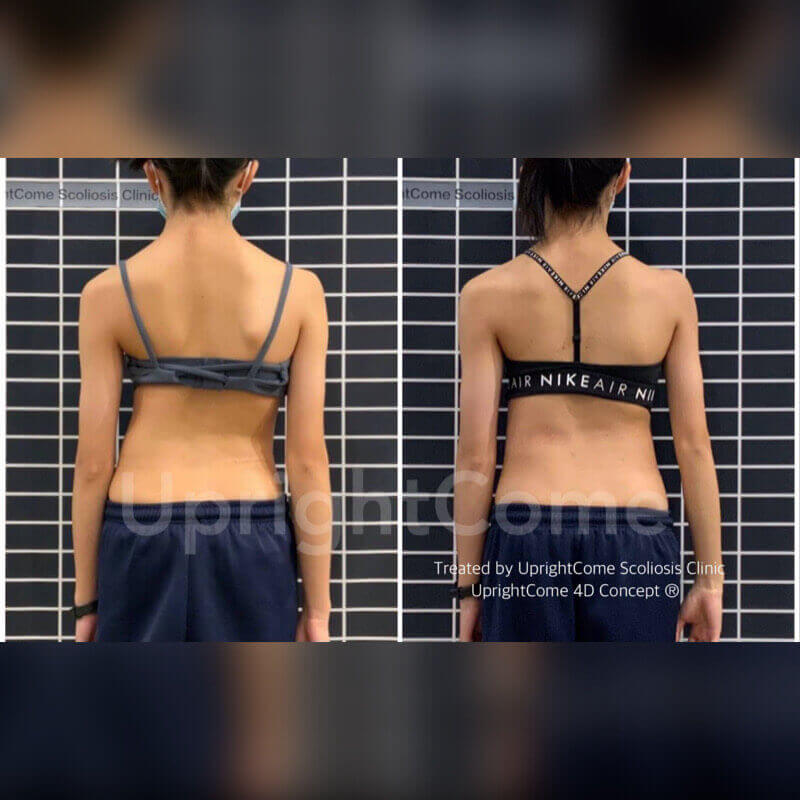 我有脊椎側彎！需要手術嗎？