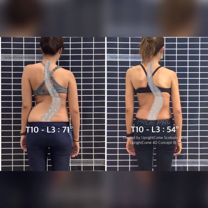 A Scoliosis Success Story – a journey from 71 degrees to 54 degrees