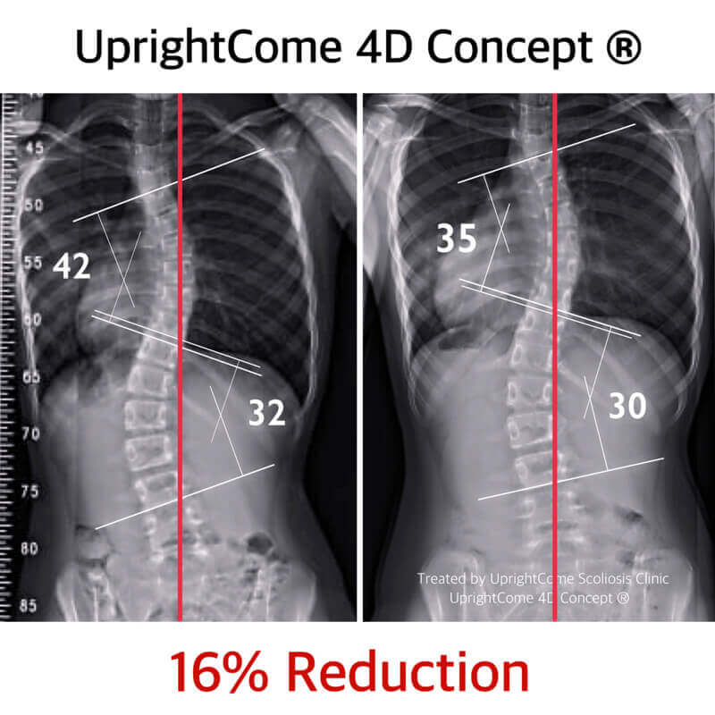 醫生說：「我的脊椎側彎，不用開刀了！」