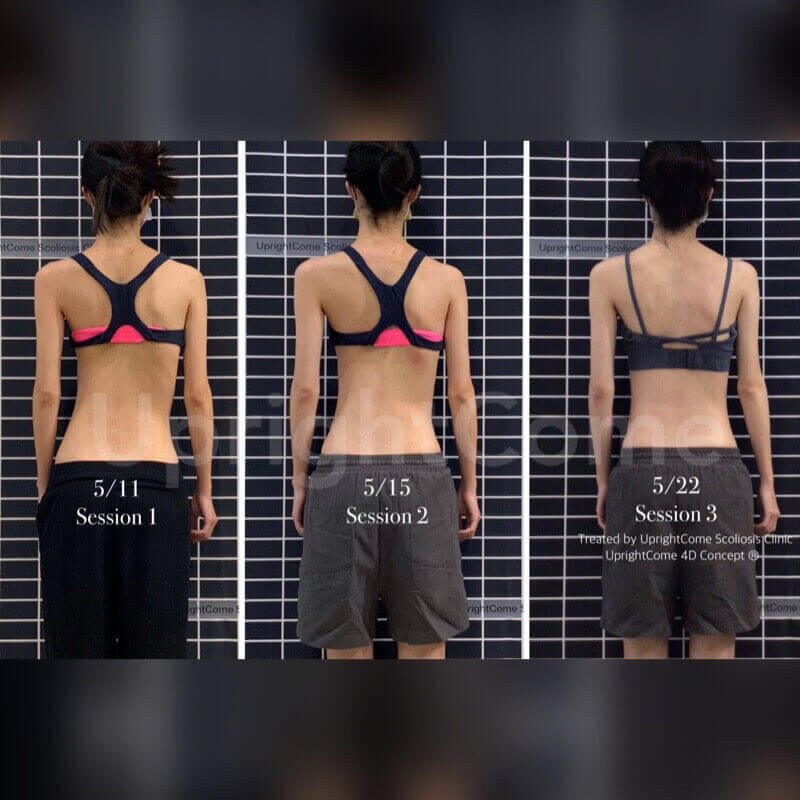 三次脊椎側彎治療，她看見了改變！