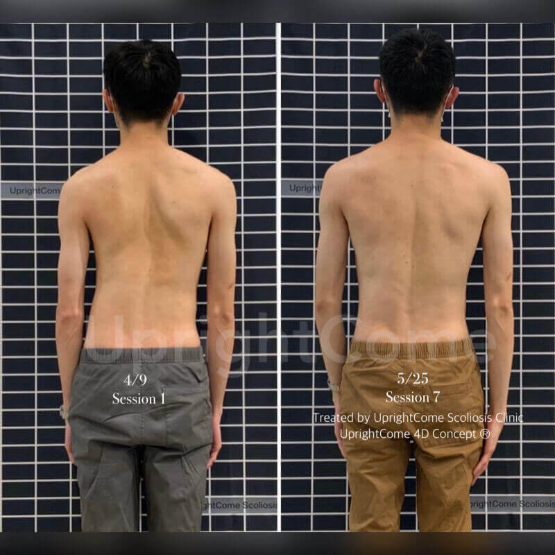 脊椎側彎治療重點之一：肩胛骨