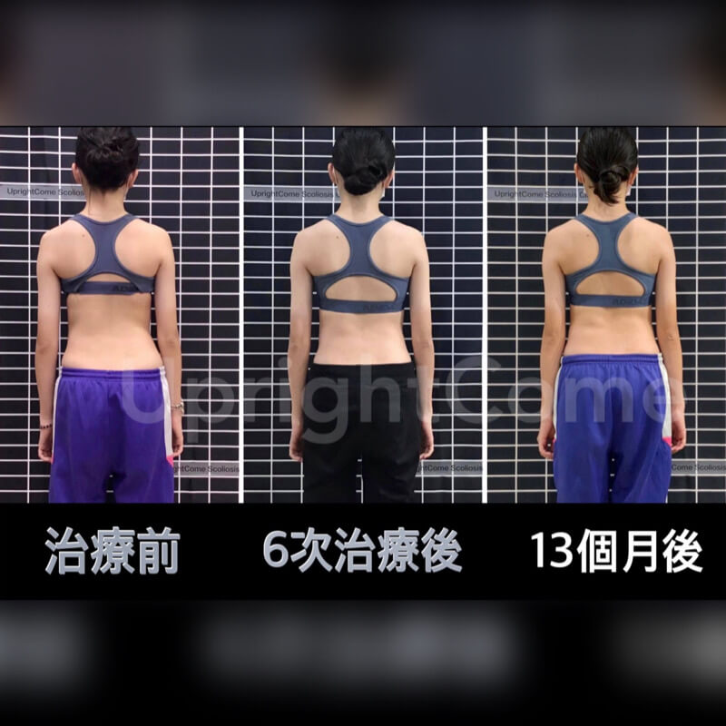 脊椎側彎矯正後效果可以維持多久？